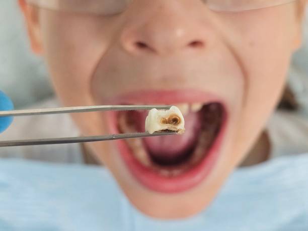 Best Urgent Care for Lost Fillings or Crowns in Seminole, FL